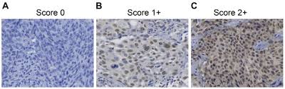 How do you know that you may have bladder cancer? Centromere Protein U Is A Potential Target For Gene Therapy Of Human Bladder Cancer