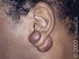 Image result for Keloid