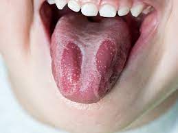 Geographic Tongue Symptoms Causes Diagnosis And Treatment