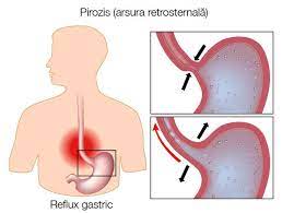 Deja a precizat că nici nu există patologie, sau nu este, și este o persoană independentă semnal de necesitatea de a schimba ceva. Arsura Retrosternala Pirozis Vs Infarct De Miocard Reginamaria Ro