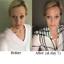 We did not find results for: Botox Basics Answering All Of Your Q A S On The Blog