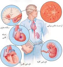 فشار خون بالا علائم علتها کاهش و درمان متخصص قلب و عروق