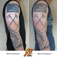 Laser tattoo removal in the comfort of your own home. Go Tattoo Removal ×'×˜×•×•×™×˜×¨ Out With The Old In With The New This Client Will Be Getting A Fresh New Sleeve After A Few More Treatments Few Things To Note