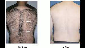 There are lots of ways to approach body hair removal for men, from body hair removal cream to waxing. Laser Hair Removal Back Off 60 Online Shopping Site For Fashion Lifestyle