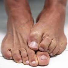 You're also at greater risk of a bacterial skin infection (cellulitis). Toe Amputation Causes Surgery Recovery And Complications