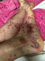 Image result for Pustular Psoriasis