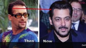 Celebrity Hair Transplant Is In News These Days Salman Khan Has Got A Hair Transplant Done It Has Become A Huge H Hair Implants Hair Clinic Hair Transplant