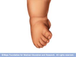 Symptoms of clubfoot foot turned inward deep crease on the bottom of the foot what is metatarsalgia? Clubfoot Disease Reference Guide Drugs Com