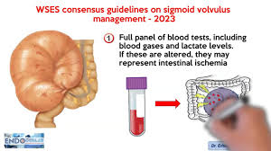 Image result for Sigmoid Volvulus