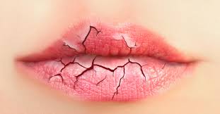 De cand eram mica am observat ca am limba crapata, fisurata! Buze CrÄƒpate Cum Le TratÄƒm Corect AflÄƒ Mai Multe Aici