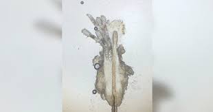 Image result for Demodex folliculorum