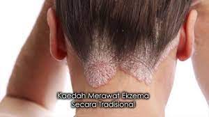 Caranya adalah dengan menyapu krim ini secara nipis pada kulit. Kaedah Merawat Ekzema Secara Tradisional