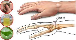 Genelde Bilek Cevresinde Ici Sivi Dolu Tumsek Benzeri Olusumlardir Her Eklemin Uzerinde Olusabilirler Ve Agriya Sebep O Saglik Saglik Ipuclari Saglik Urunleri