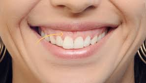 Maybe you would like to learn more about one of these? Gummy Smile Bristol Ciao Bella Aesthetics