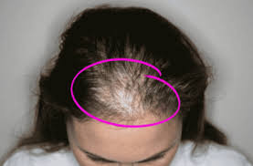 What steps can i take to prevent or slow hair loss? 9 Signs Of Hashimoto S Disease And How To Treat It Hair Loss Women Regrow Hair Hair Loss Remedies