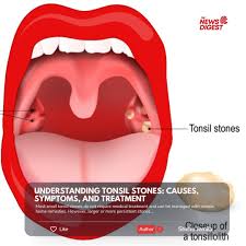 Image result for Tonsillolith