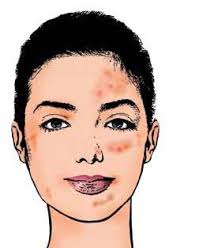 • anticonceptiepillen die twee hormonen bevatten, worden. 4 2 Systemische Behandeling Van Acne Issuu