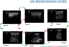 Image result for Air Bronchogram