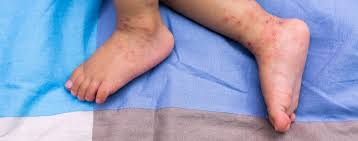 Erkrankte kinder sind vor allem in der inkubationszeit ansteckend, also bis. Roteln Focus Arztsuche