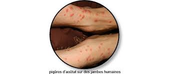 La piqûre d'aoûtat laisse sur la peau une zone rouge et peuvent entraîner des fièvres. Aoutats Chez Le Chat Traitement Conseil Veto Illustre Catedog