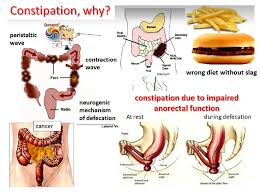 Image result for Constipation in Cancer