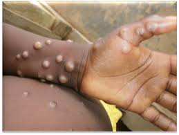 Two cases of monkeypox have been reported in north wales, health officials have said monkeypox is commonly found in central and west africa. Laurie Garrett On Twitter Breaking The Cdcgov Texas Dept Of State Health Services Confirms A Case Of Human Monkeypox In A U S Resident Who Recently Traveled From Nigeria To The U S