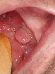 Image result for spinocellular carcinoma of the oral cavity