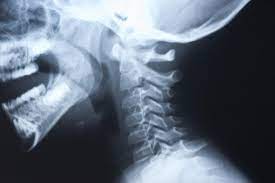 I am a 19 year old male. Dysphagia Symptoms Diagnosis And Treatment