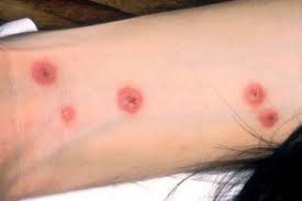 Stevens Johnson Syndrome Nhs