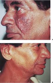 The comedones are widened openings for hair follicles and sebaceous glands filled with material. Favre Racouchot Syndrome Semantic Scholar
