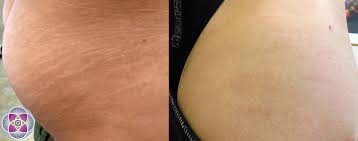 The fractional co2 laser is commonly used for. Trage Ideologie A Impune Laser Treatment For Stretch Marks Lmvdesigns Com