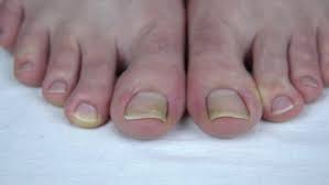 Image result for Yellow nail syndrome feet