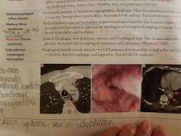 Plummer's nail is a clinical sign in which there is onycholysis, or separation of the nail from the nail bed for faster navigation, this iframe is preloading the wikiwand page for plummer's nail. Mcat Memoranda Plumbers Die Plummer Vinson Syndrome