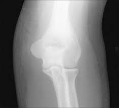 Image result for Coronoid Process Fracture