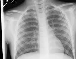 When looking at a radiograph, remember that it determine if it is from a lateral decubitus position. Chest Radiograph