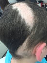 Get the tutorial at jess oakes. Frontiers A Practical Approach To The Diagnosis And Management Of Hair Loss In Children And Adolescents Medicine