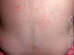 Image result for sweat rash on back baby
