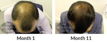 Too much of stress and medicines can give rise to premature baldness, which can degrade your confidence level to another level. Kirkland Minoxidil Hair Loss Treatment