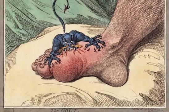 The disease of kings?' 1 in 20 Australians get gout — here's how to manage  it