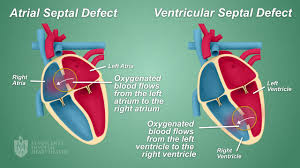 Image result for Ventricular Septal Defect