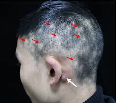 When your scalp itches, it can be difficult to think about anything else. Hair Loss And Lymphadenopathy The Bmj