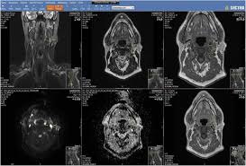 Cross Sectional Imaging In Cancers Of The Head And Neck How We Review And Report Cancer Imaging Full Text