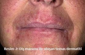 Alerjik Kontakt Alerji Klinigi