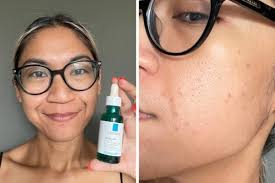 Maybe you would like to learn more about one of these? 5 Girls Tried La Roche Posay S Effaclar Serum To See If They Could Get Smooth Clear Even Skin After 1 Month Zula Sg