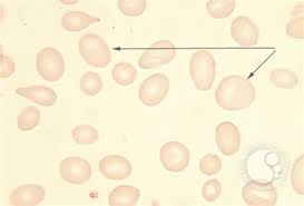 Image result for Anemia angolensis