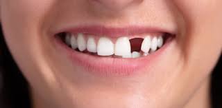 Wisst ihr, ab wann man mit dem mutterschutzgeld der krankenkasse rechnen kann? Krankenkassen Ab 2020 Gibt Es Fur Zahnersatz Mehr Zuschuss Zwp Online Das Nachrichtenportal Fur Die Dentalbranche