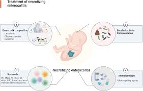 Image result for Necrotizing Enterocolitis