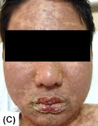 면역혈소판감소자색반병 환자에서 리툭시맙 투여 후 발생한 독성표피괴사용해