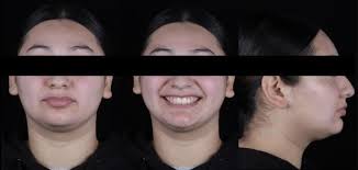 Orthodontic-surgical treatment of skeletal class II malocclusion: A case  report