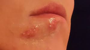 Diese machen sich bei einnahme säurehaltiger speisen durch brennende schmerzen bemerkbar. Was Kann Ich Gegen Weisse Blaschen Unter Der Lippe Tun Sind Das Fieberblaschen Gesundheit Blaeschen